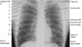 Chest X-ray, labeled. Attribution-Share Alike 3.0 Unported licensing, attributed to Chikumaya and Mikael Häggström