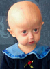 A child with a type of progeroid syndromes