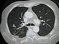 CT image of a lung metastasis