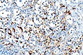 S100 immunostain highlighting the sustentacular cells in a paraganglioma