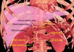 3D rendered CT of abdominal aortic branches and kidneys Attribution-Share Alike 3.0 Unported licensing, attributed to I-Chen Tsai and Mikael Häggström