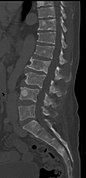 CT scan of the lower vertebral column in a man with multiple myeloma, showing multiple osteoblastic lesions: These are more radiodense (brighter in this image) than the surrounding cancellous bone, in contrast to osteolytic lesions, which are less radiodense.