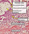 Histopathology of a chorionic villus, in a tubal pregnancy, with labeled cytotrophoblasts and syncytiotrophoblasts.