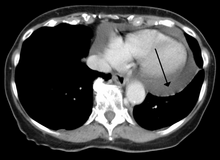 A CT scan showing a pericardial effusion