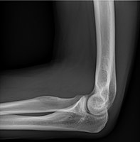 Normal elbow, lateral projection