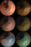 Endoscopic images of an early stage stomach cancer. 0-IIa, tub1. Left column: Normal light. Right column: computed image enhanced (FICE). First row: Normal. Second row: Acetate stained. Third row: Acetate-indigocarmine mixture (AIM) stained.