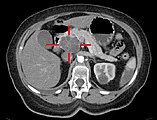 Axial CT image showing a macrocystic adenocarcinoma of the pancreatic head