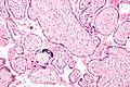 Micrograph of a placental infection (CMV placentitis)
