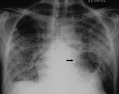 X-ray of a cyst in pneumocystis pneumonia[7]
