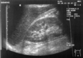 Ultrasound of liver (left side of the image) and right kidney (right side of the image) and Morison's pouch, not containing fluid