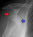 Anterior dislocation of the right shoulder. AP X ray