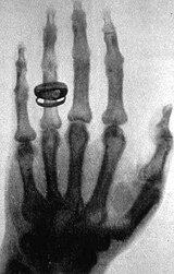 Röntgenaufnahme der Hand von Albert von Kölliker, die Röntgen als Demonstrationsobjekt verwendete