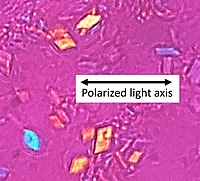 In contrast, CPPD (pseudogout) displays rhombus-shaped crystals with positive birefringence.