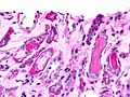 Micrograph showing myeloma cast nephropathy in a kidney biopsy: Hyaline casts are PAS positive (dark pink/red – right of image). Myelomatous casts are PAS negative (pale pink – left of image), PAS stain.