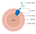 Dukes stage C bowel cancer; the cancer has invaded the nearby lymph nodes.