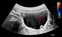 Figure 21. Left hydroureter with ureteric jet. No stone is visible. The red color in the color box represents motion towards the transducer as defined by the color bar.[1]
