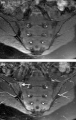 Magnetic resonance images of sacroiliac joints. Shown are T1-weighted semi-coronal magnetic resonance images through the sacroiliac joints (a) before and (b) after intravenous contrast injection. Enhancement is seen at the right sacroiliac joint (arrow, left side of the image), indicating active sacroiliitis.