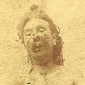 Mortuary photograph of Eddowes. Her lower face is severely mutilated