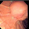 Common bile duct stone impacted at ampulla of Vater seen at time of endoscopic retrograde cholangiopancreatography (ERCP)